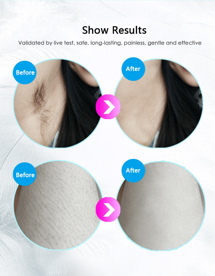 ZyraBeauty Laser Hair Removal Device – IPL Home Hair Remover with 5 Intensity Levels & 350,000 Flashes | Full Body Painless Treatment for Smooth Skin